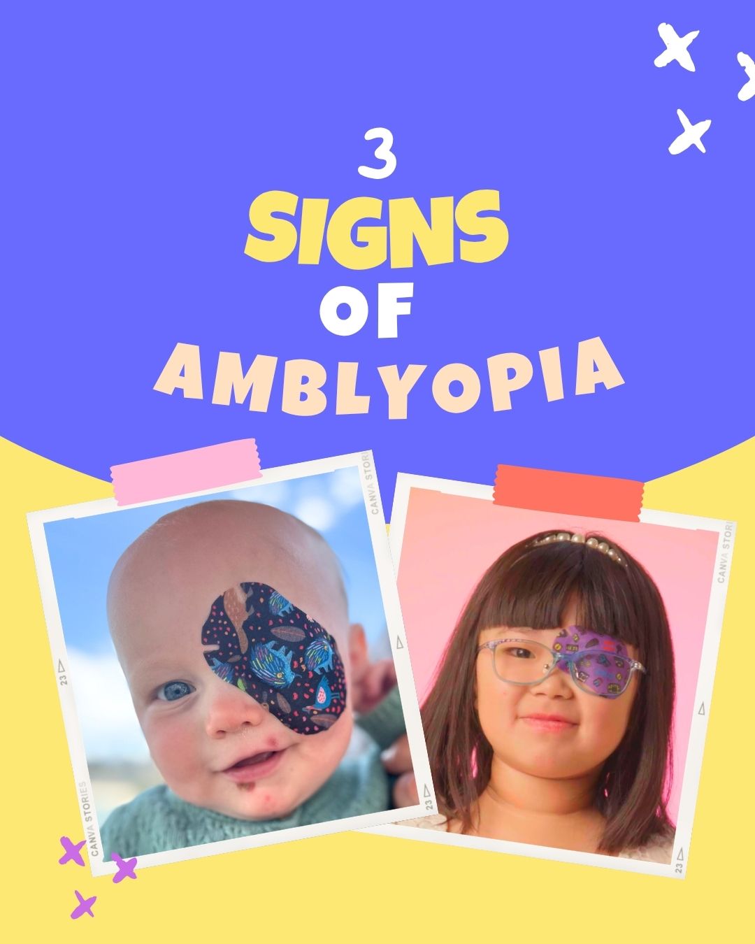 3 Amblyopia Signs